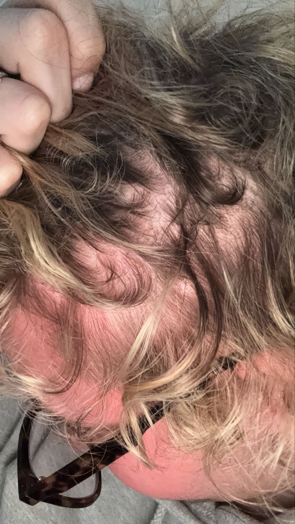 Customer after — visible scalp improvement and reduced inflammation following consistent use