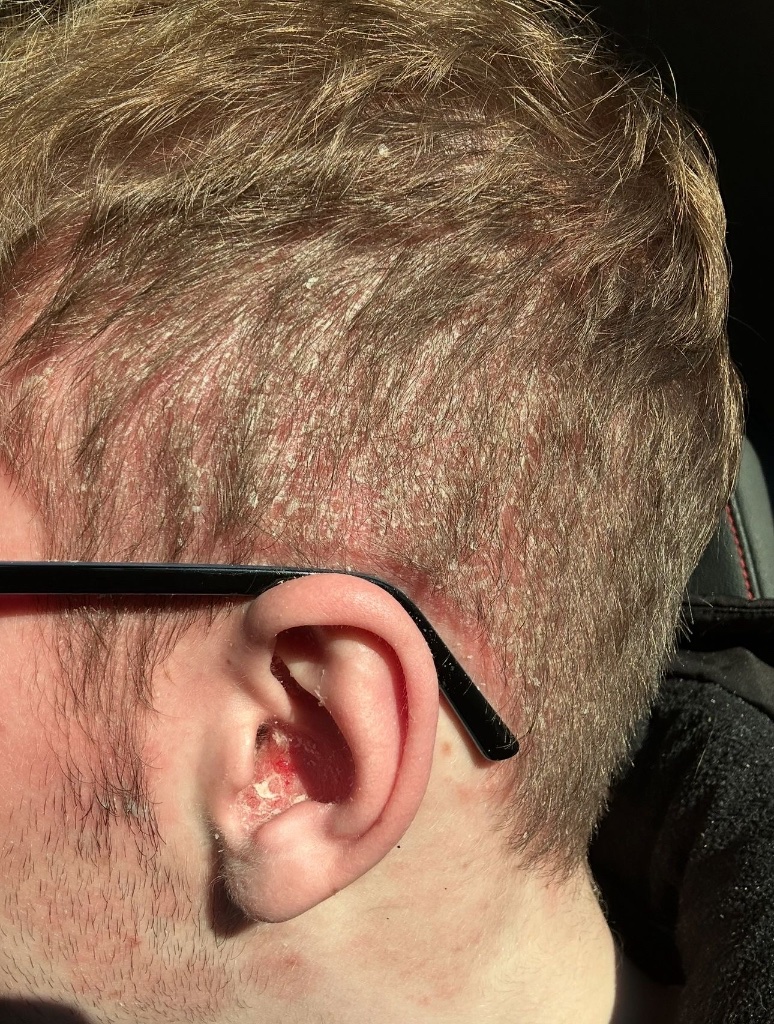 Customer before — scalp psoriasis with associated hair thinning