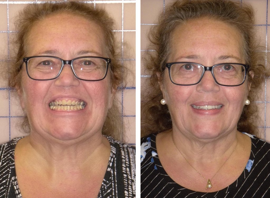 Patient's smile transformation