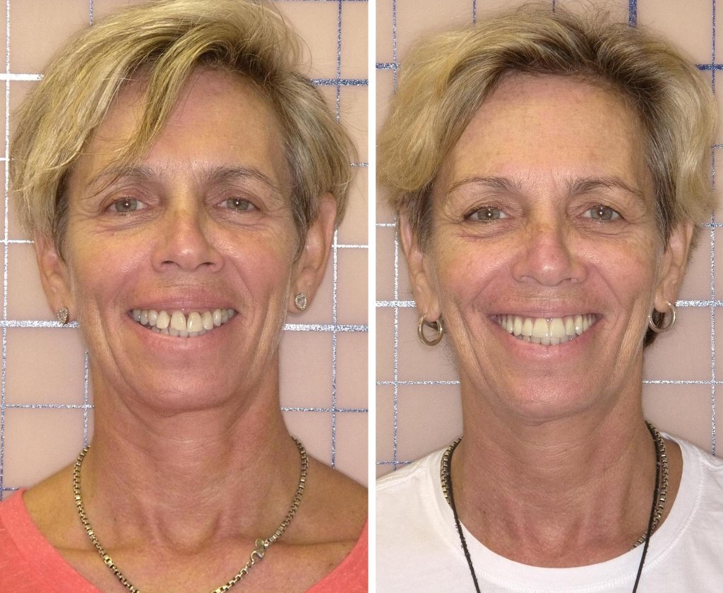 Patient's smile transformation