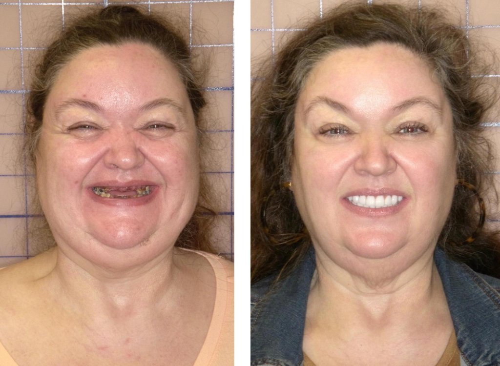 Patient's smile transformation