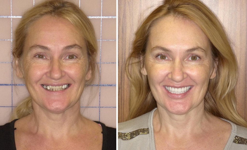 Anastasia's smile transformation