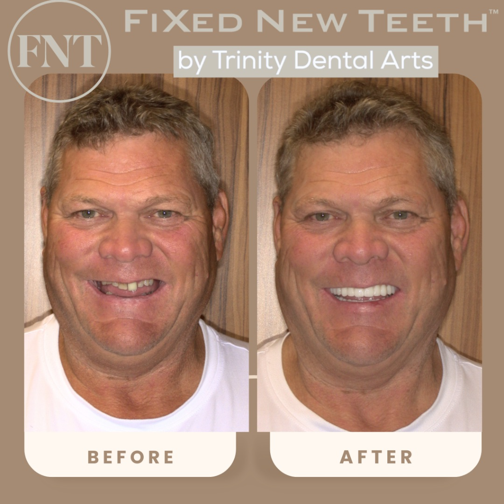 Before and after dental transformation — patient 1