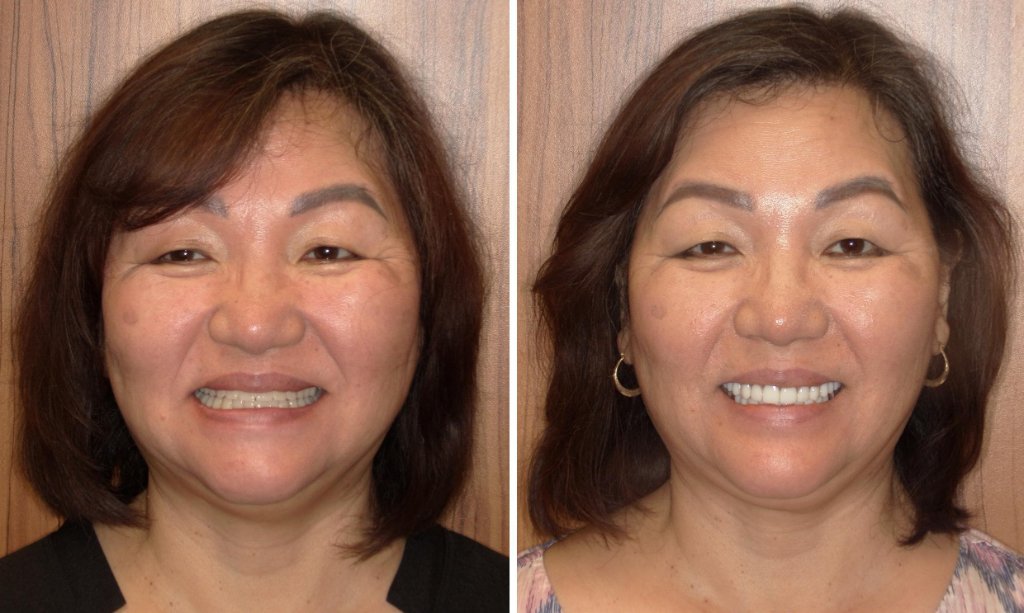Hee's smile transformation