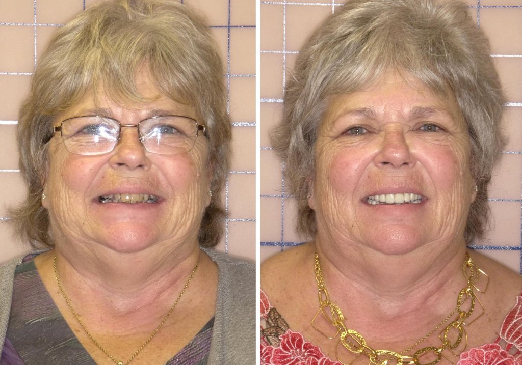 Patient's smile transformation