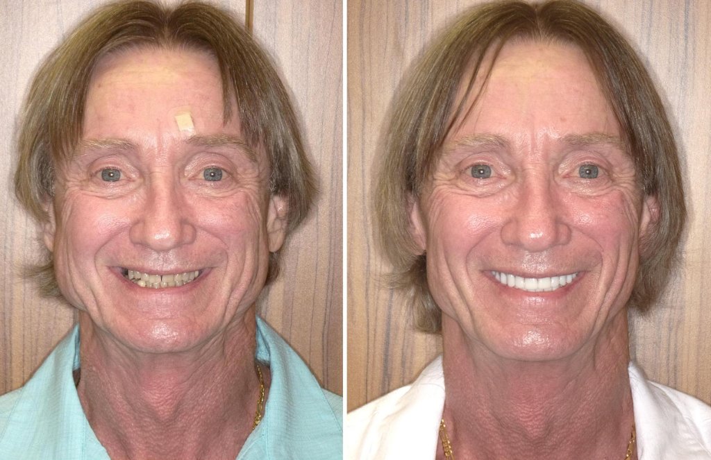 John C.'s smile transformation