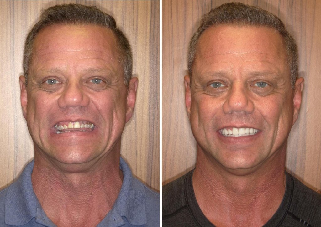Jim's smile transformation
