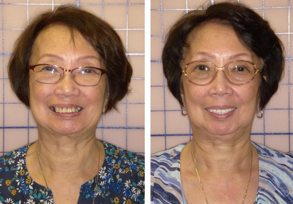 Patient's smile transformation