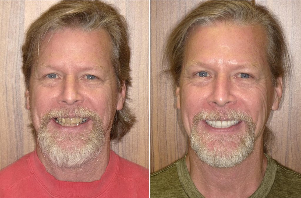 Robin's smile transformation