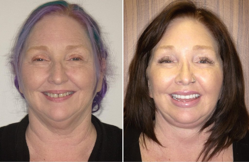 Susan's smile transformation