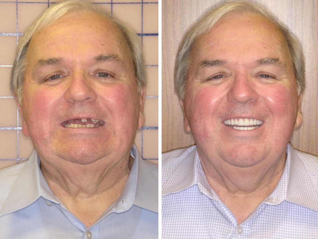 Carl's smile transformation