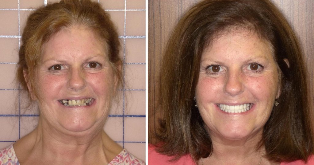 Mary's smile transformation
