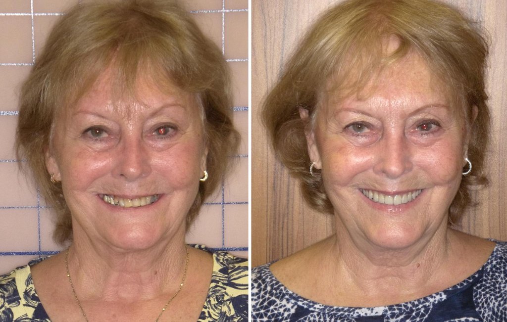 Linda's smile transformation