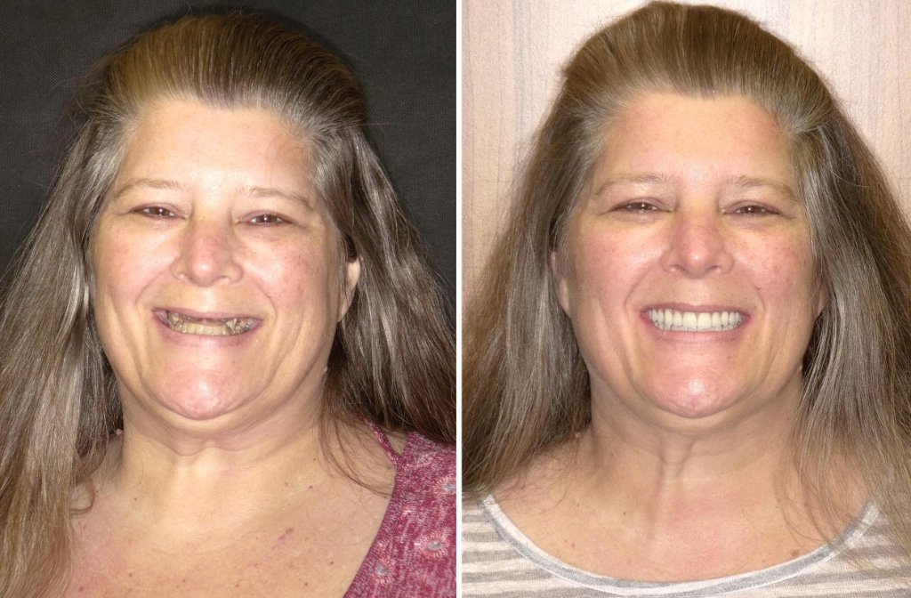 Faith's smile transformation