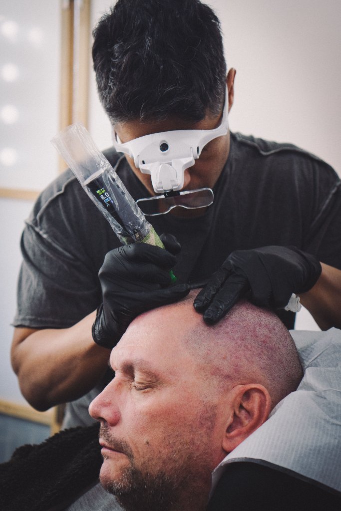 Scalp Micropigmentation