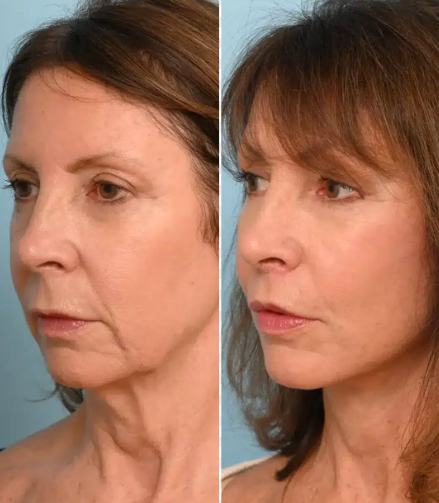 CO₂ Laser Resurfacing