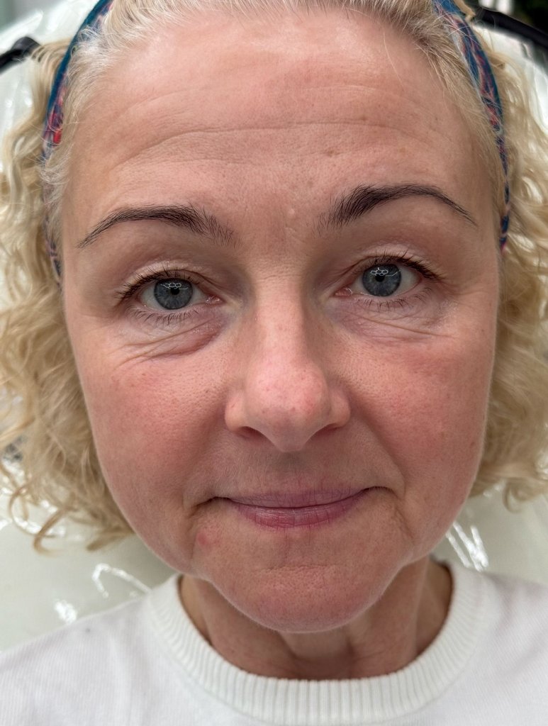 Vicki before CO2 Laser