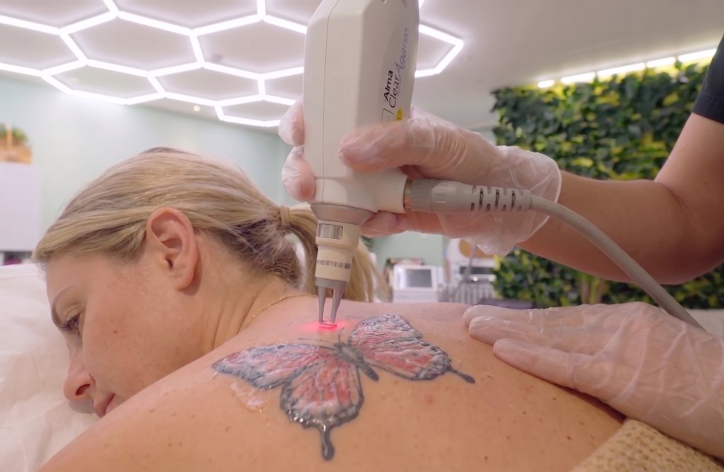 Permanent Laser Tattoo Removal