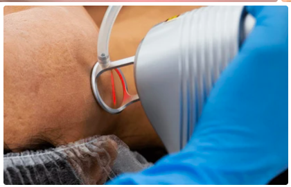 CO2 Laser Resurfacing