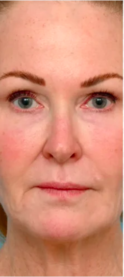 Before treatment