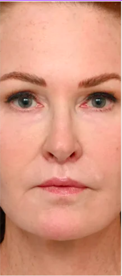 After treatment