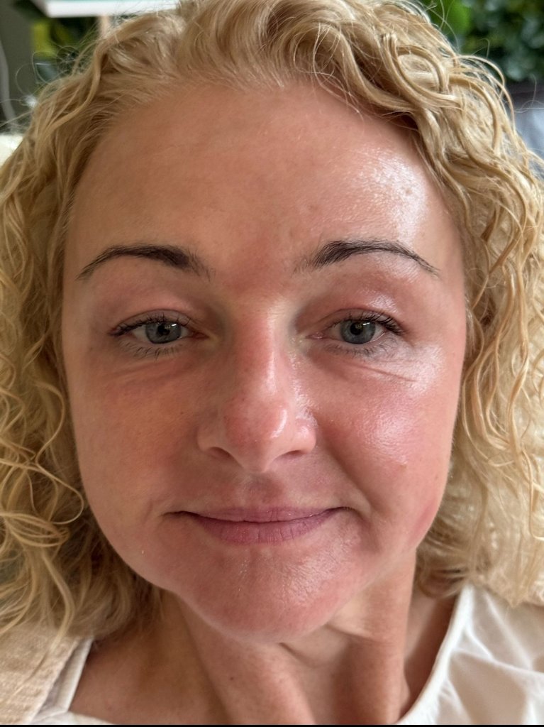 Vicki after CO2 Laser