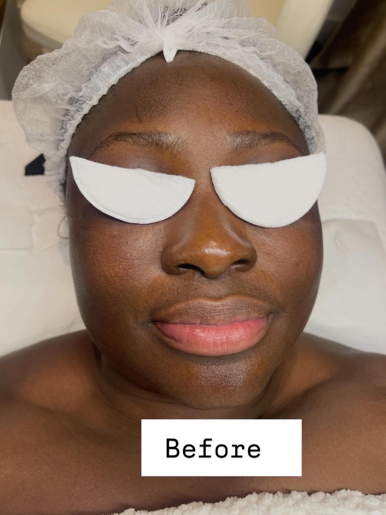 Before treatment