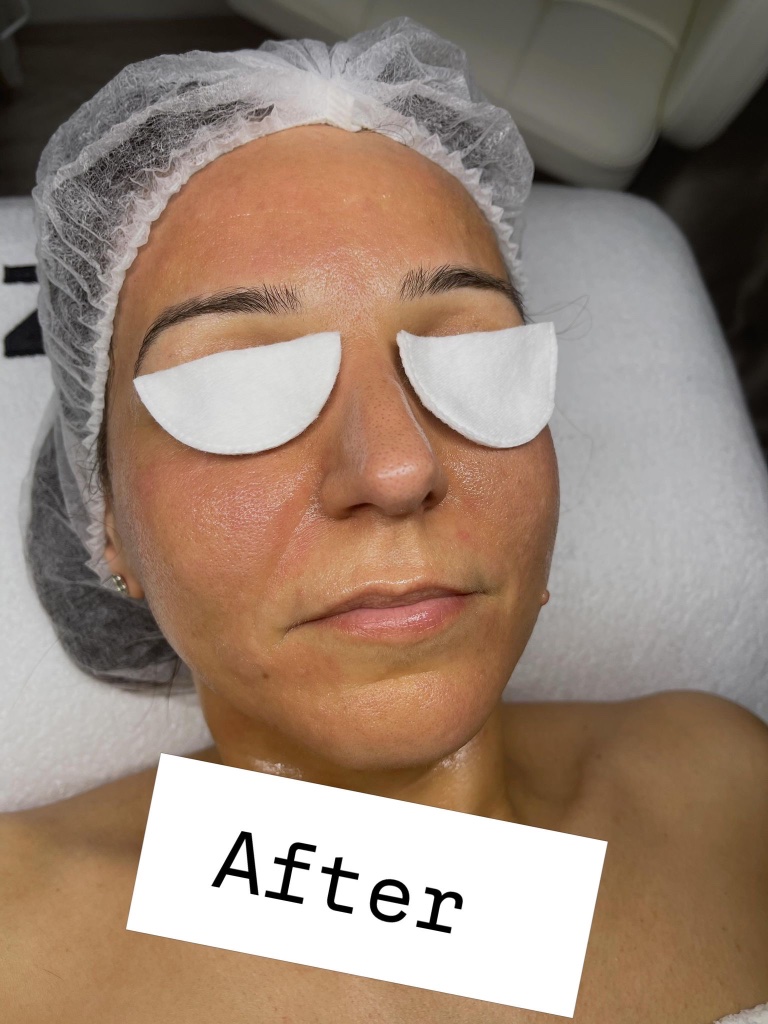 After facial treatment