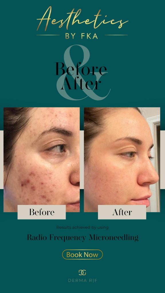 Acne Scarring & Skin Clarity before