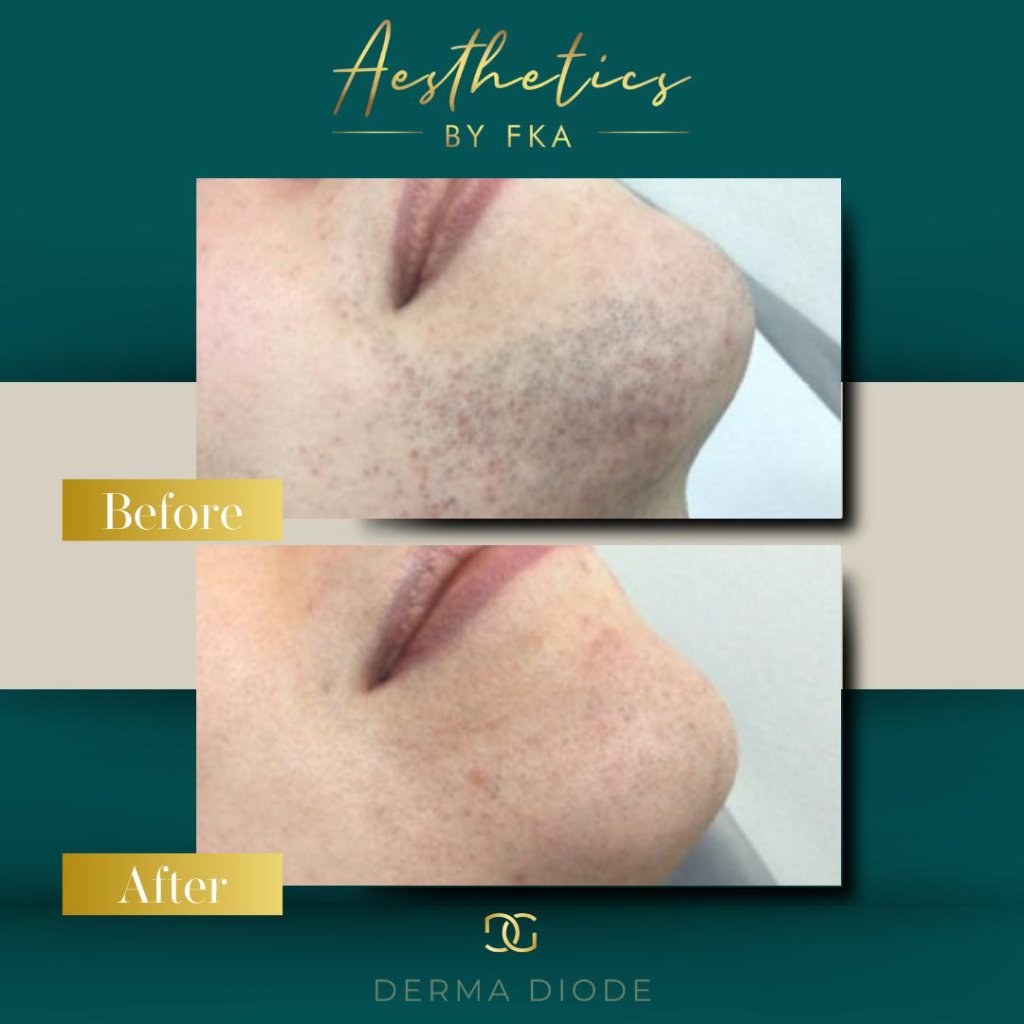 Laser Hair Removal before and after 1 before