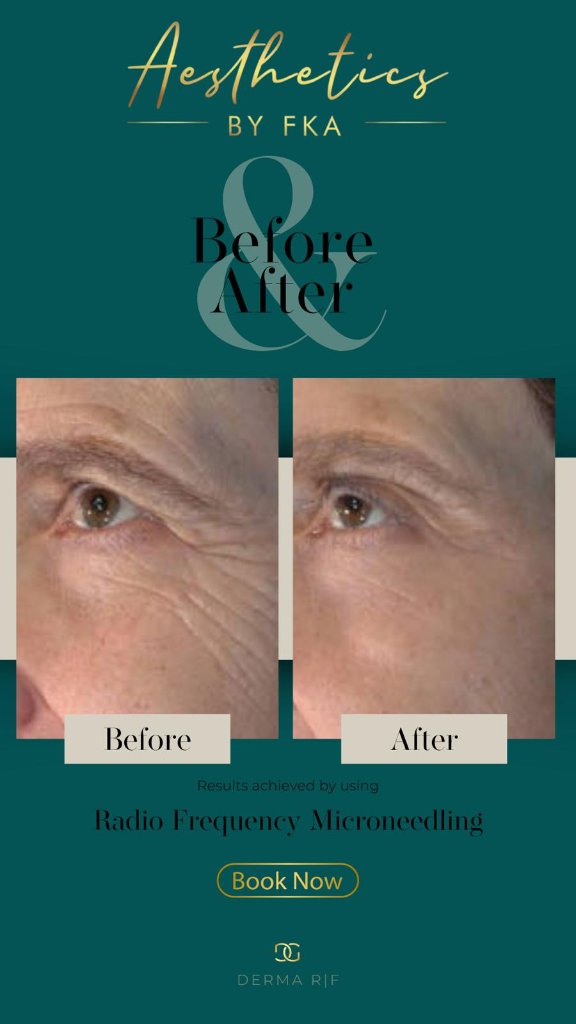 Laser Hair Removal before and after 2 before
