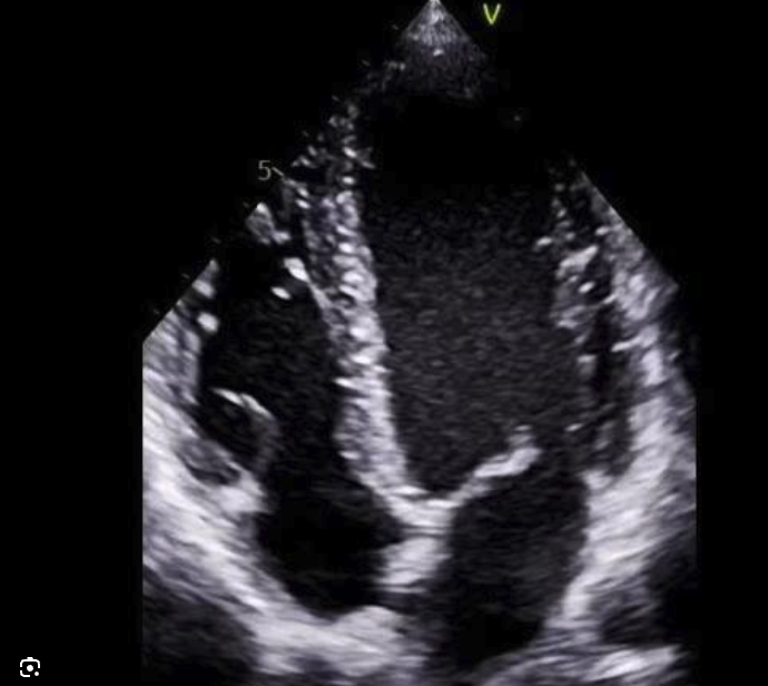 Apical four chamber echocardiogram