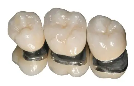 Krone Metallkeramik