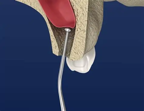 Sinuslift (Kieferhöhlenaugmentation)