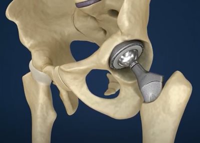 Orthopaedic hip implant that includes a femoral ball
