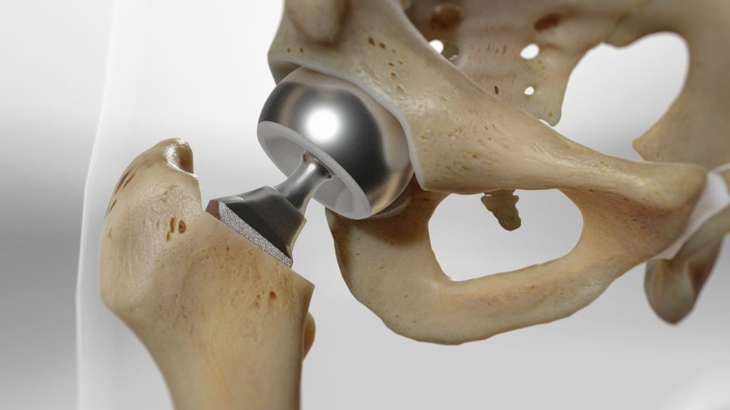 On the ball with hip implants in orthopedic