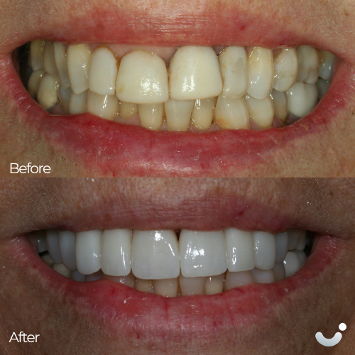 Before & After