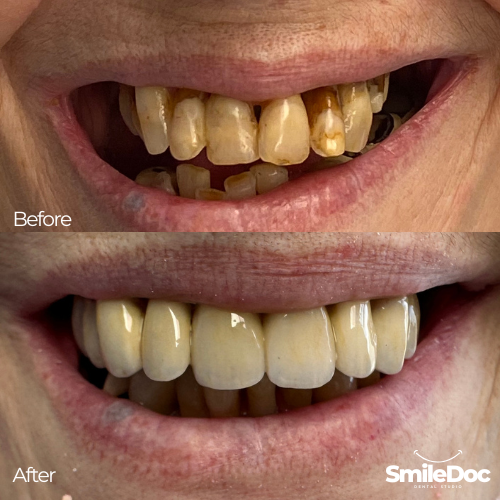 Before & After