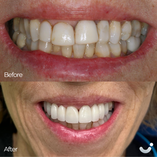 Before & After