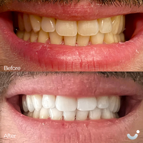 Before & After