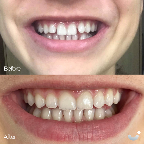 Before & After