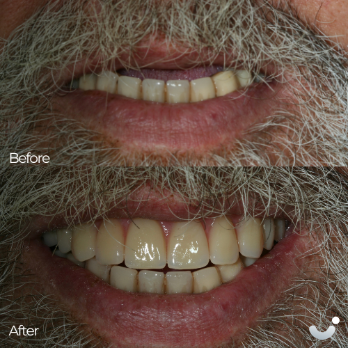 Before & After