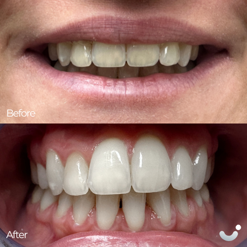 Before & After
