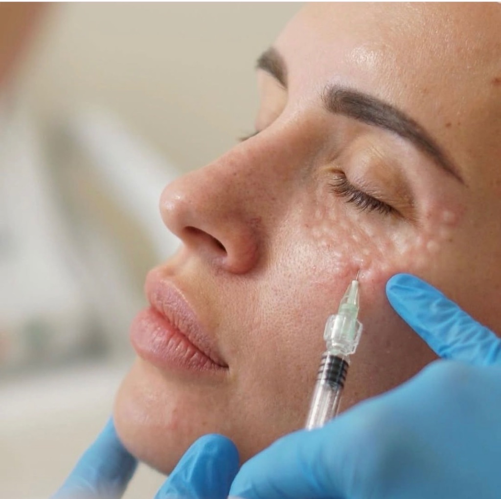 Polynucleotides at Luminè Clinic London — doctor-led aesthetic medicine by GMC-registered physicians
