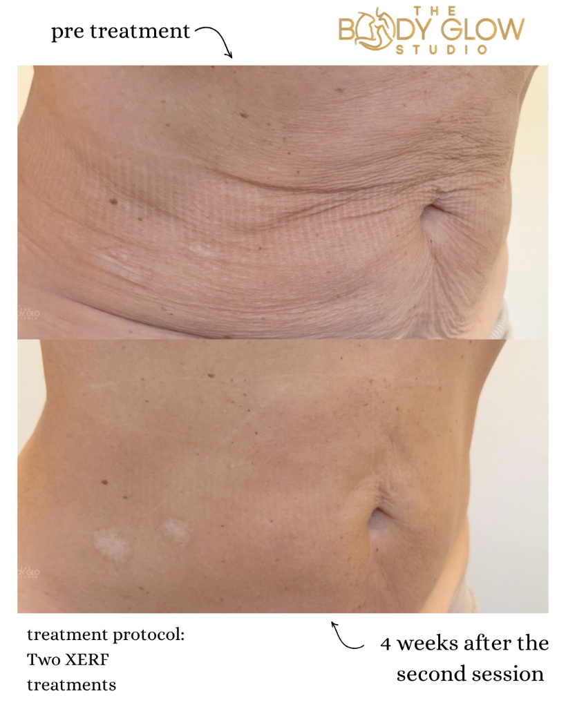 Abdomen