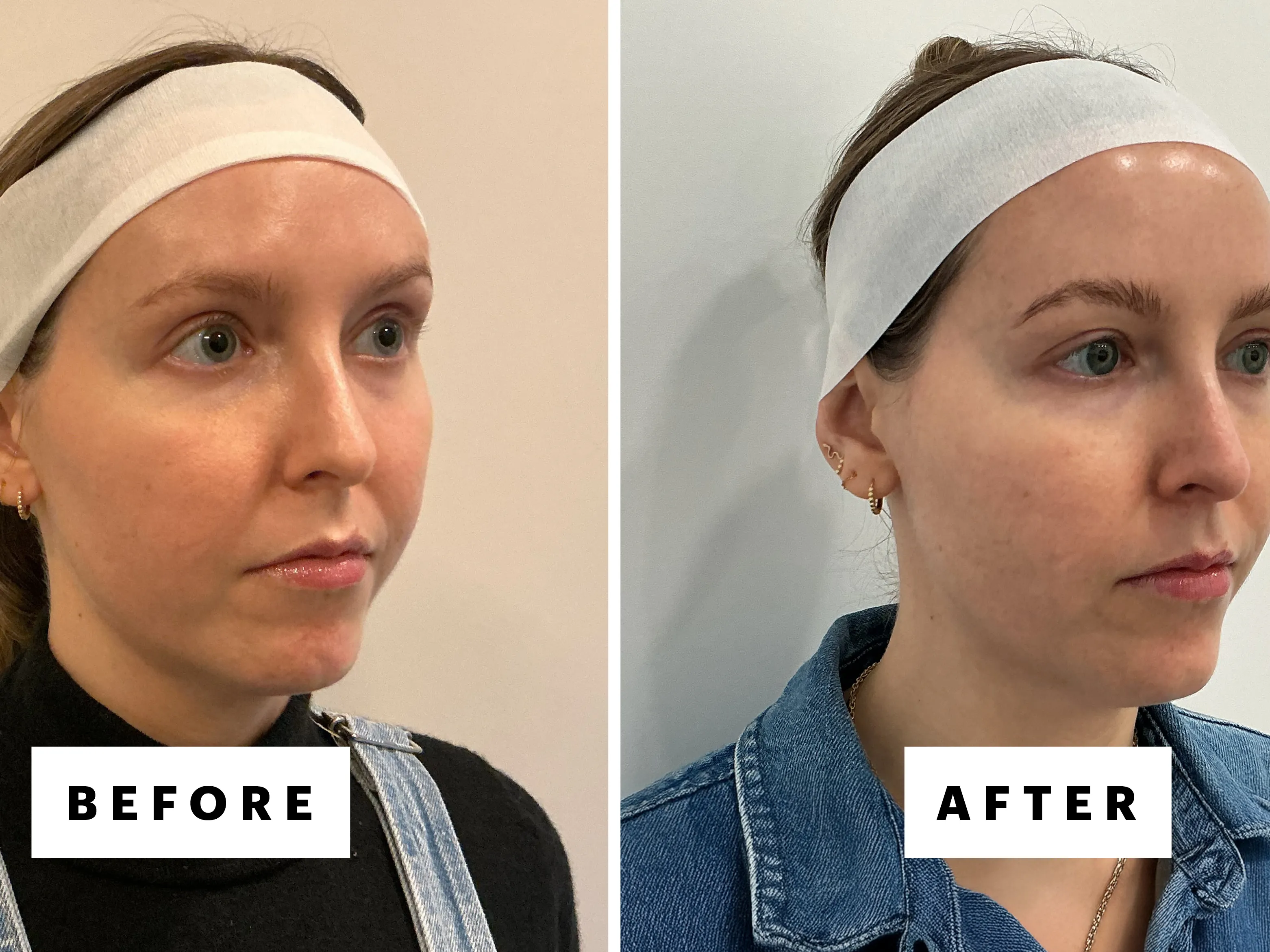 Tightening Loose Skin After GLP-1 Weight Loss in Boca Raton: XERF & Ultraformer MPT