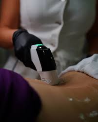 Ultraformer MPT Body Tightening in Boca Raton: Abdomen, Thighs & More