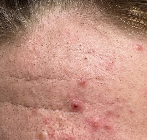 Acne