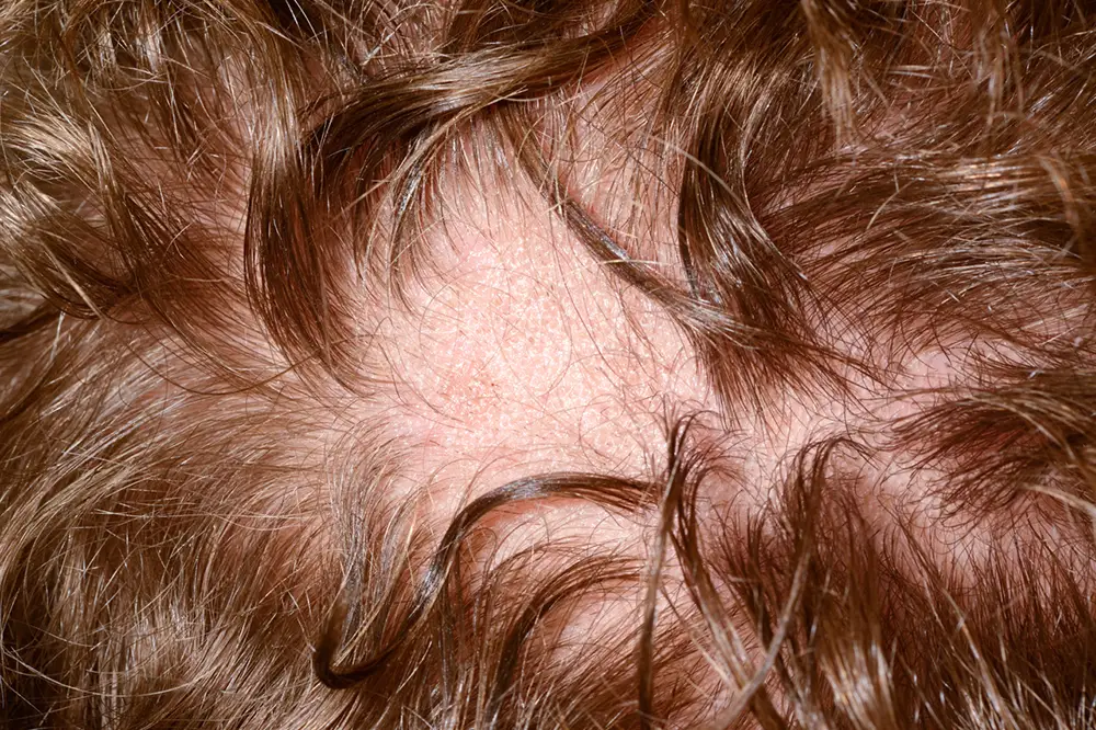 Alopecia areata