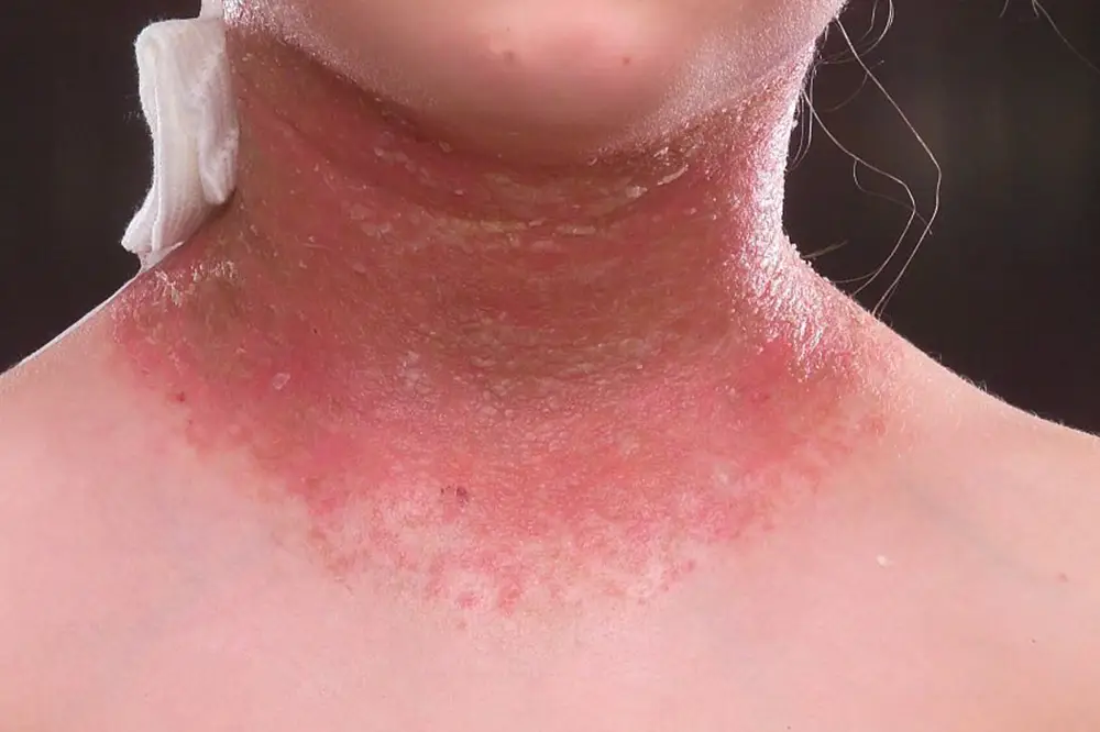 Eczema and dermatitis